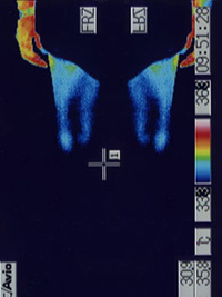 Thermography test for lymphatic status