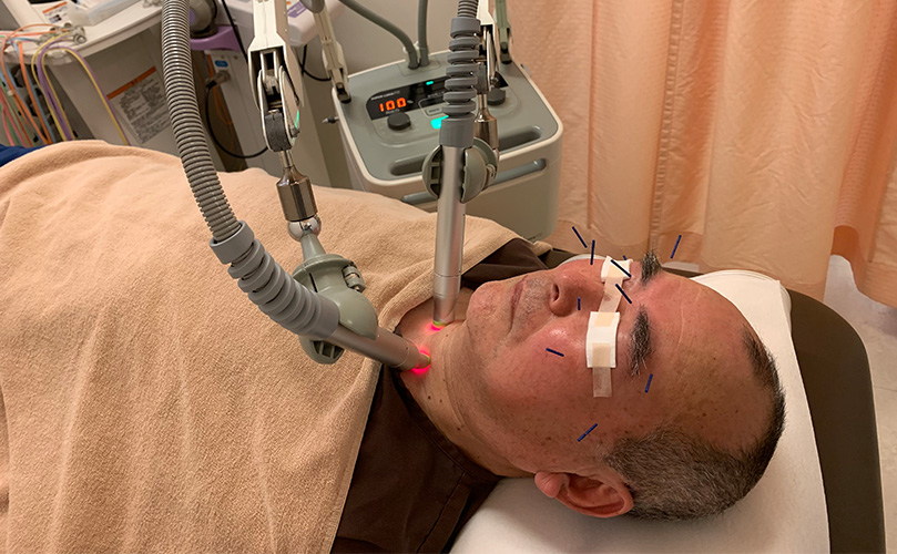 Treatment of stellate ganglion with super riser