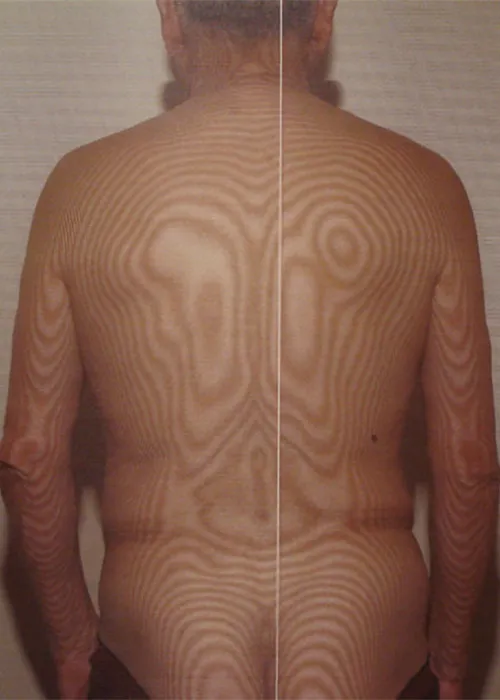 Using Moiré Topography to assess balance
