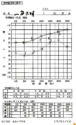 Sudden hearing loss|5 months after onset