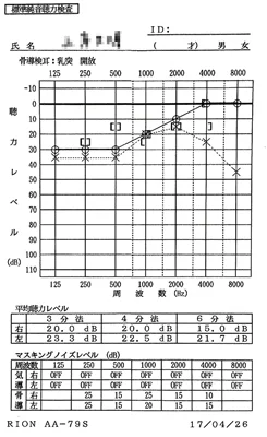 Sudden hearing loss|8 months after onset