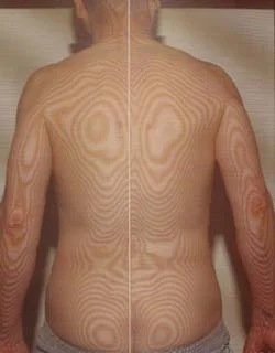 耳硬化症症｜鍼治療で歪みが治った体（治療後）