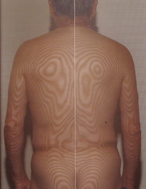 Calf blood flow improved by acupuncture｜Thermographic image after treatment