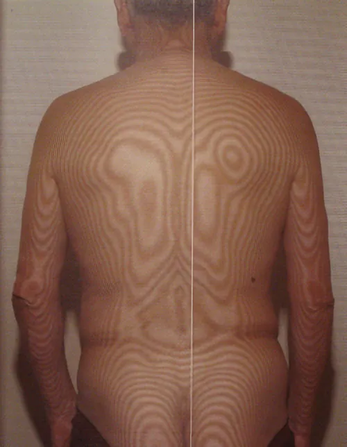 Thermographic image before treatment