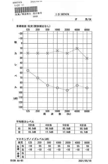 Sudden hearing loss with total deafness in one ear | Audiogram (After)