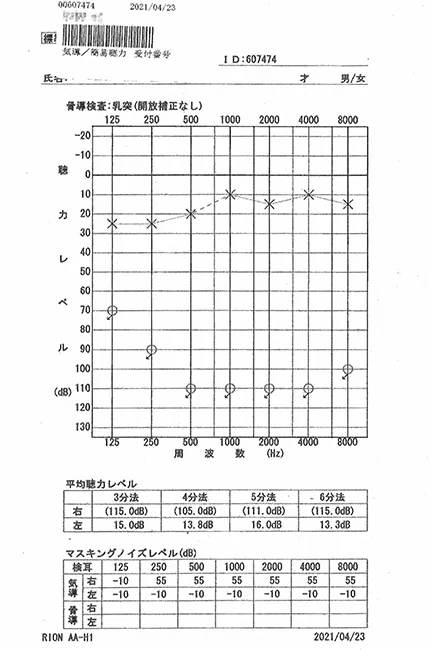 Sudden hearing loss with total deafness in one ear | Audiogram (Before)