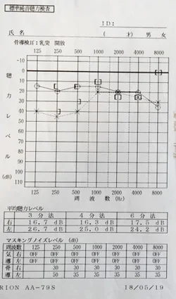 Sudden hearing loss before acupuncture