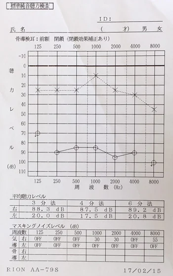 Sudden hearing loss before acupuncture